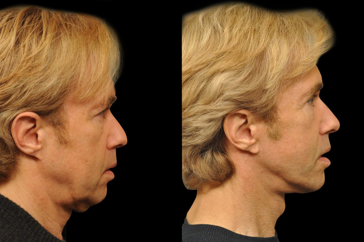 Chin Augmentation Before & After Gallery - Patient 336757 - Image 4