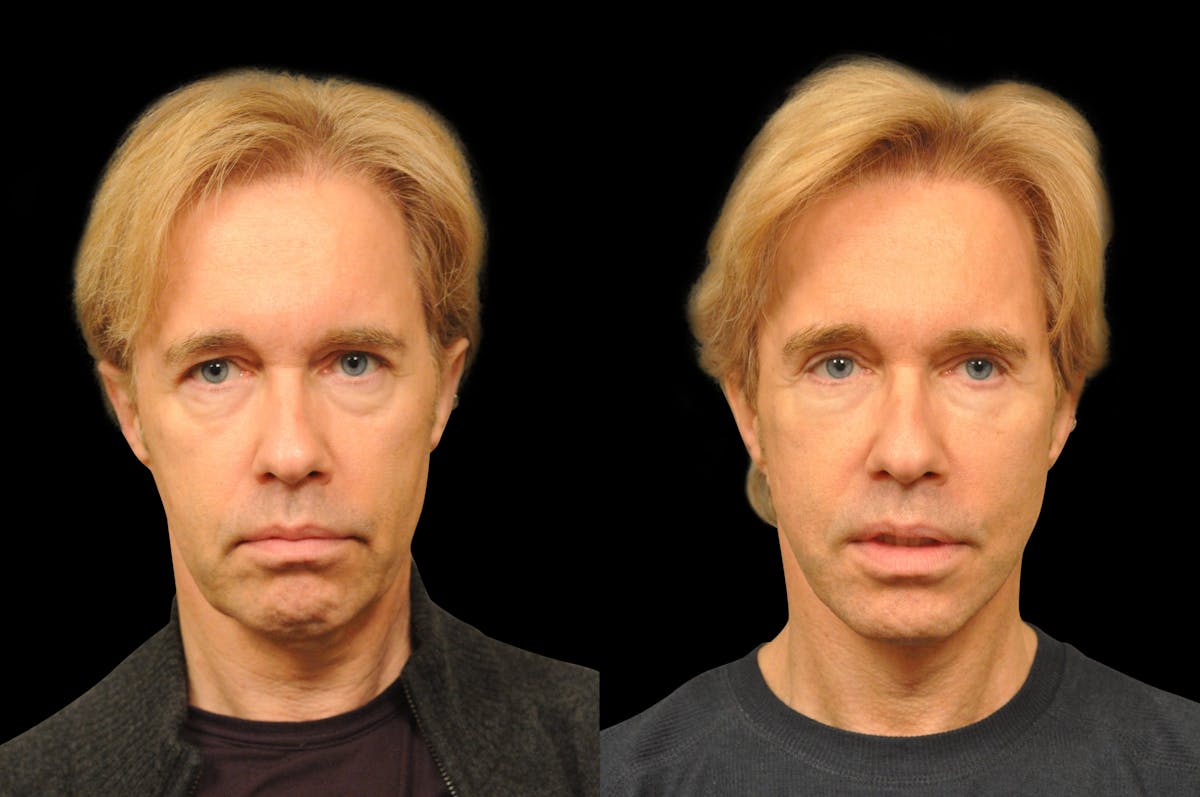 Chin Augmentation Before & After Gallery - Patient 336757 - Image 5
