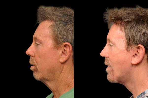 Chin Augmentation For Men Before & After Gallery - Patient 148390 - Image 1