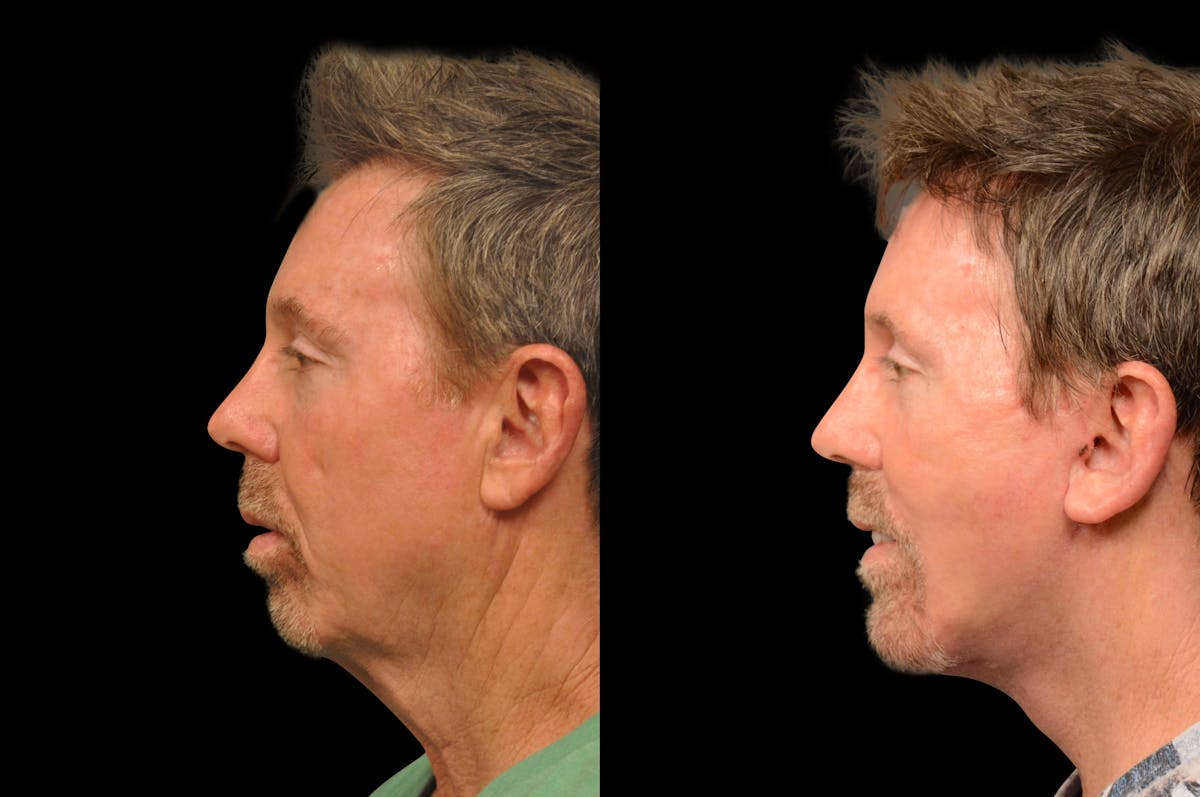 Neck Lift Before & After Gallery - Patient 249910 - Image 2