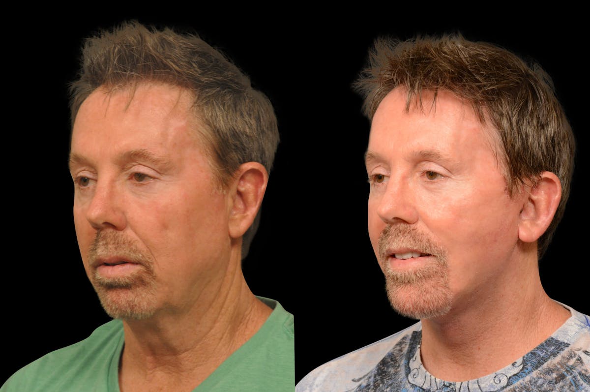 Chin Augmentation Before & After Gallery - Patient 148390 - Image 2