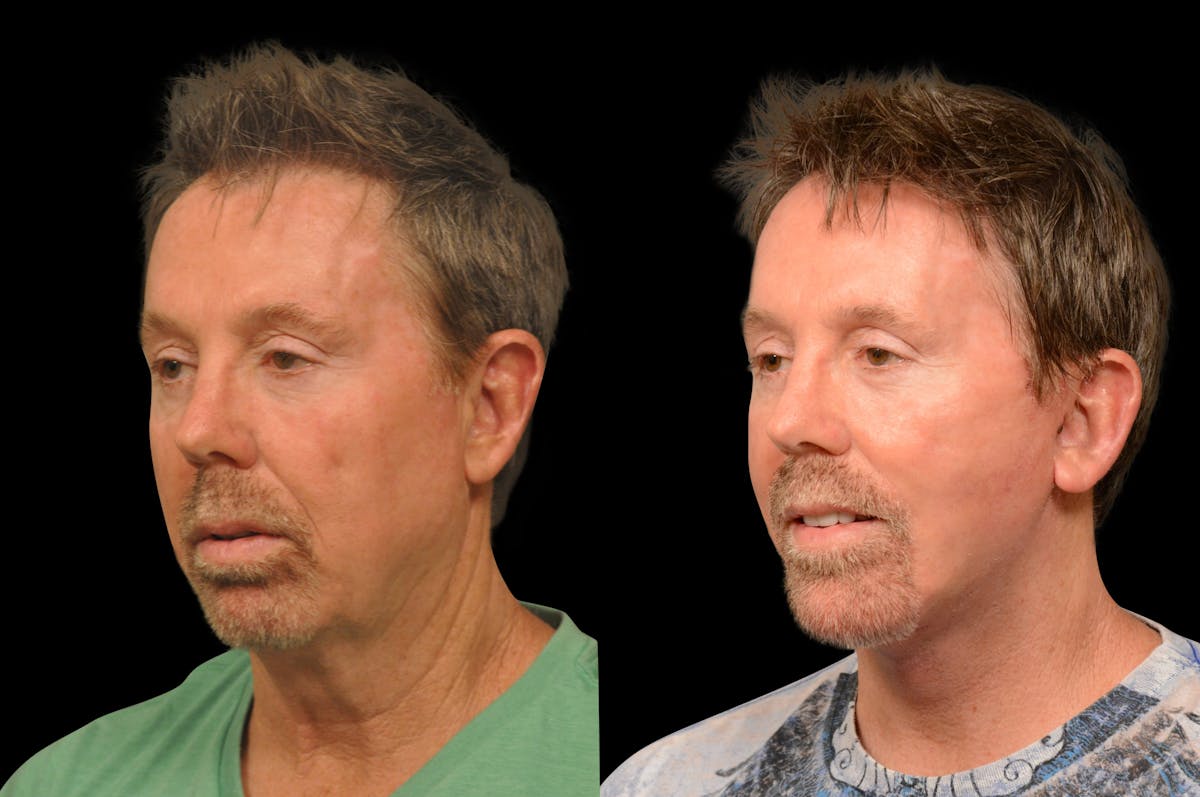 Changes Rapid Lift For Men Before & After Gallery - Patient 694341 - Image 1