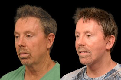 Neck Lift Before & After Gallery - Patient 249910 - Image 1