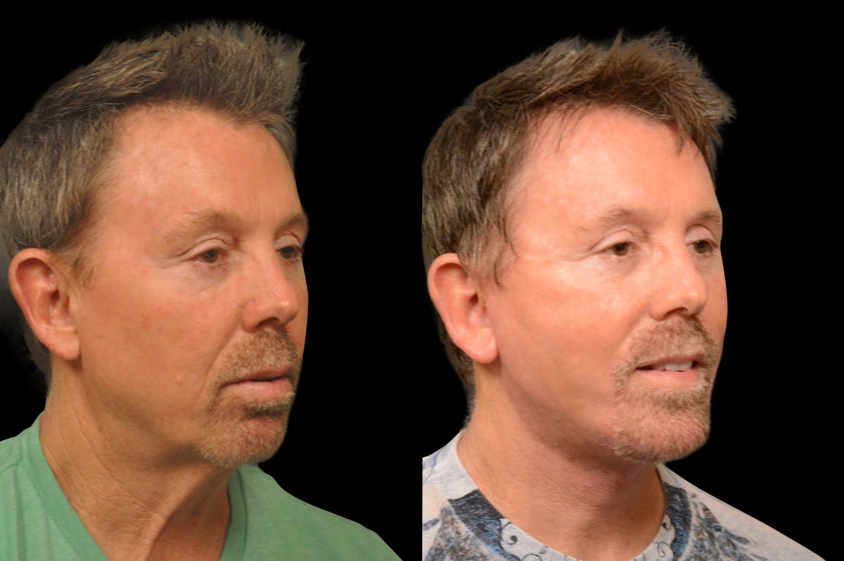 Changes Rapid Lift For Men Before & After Gallery - Patient 694341 - Image 3