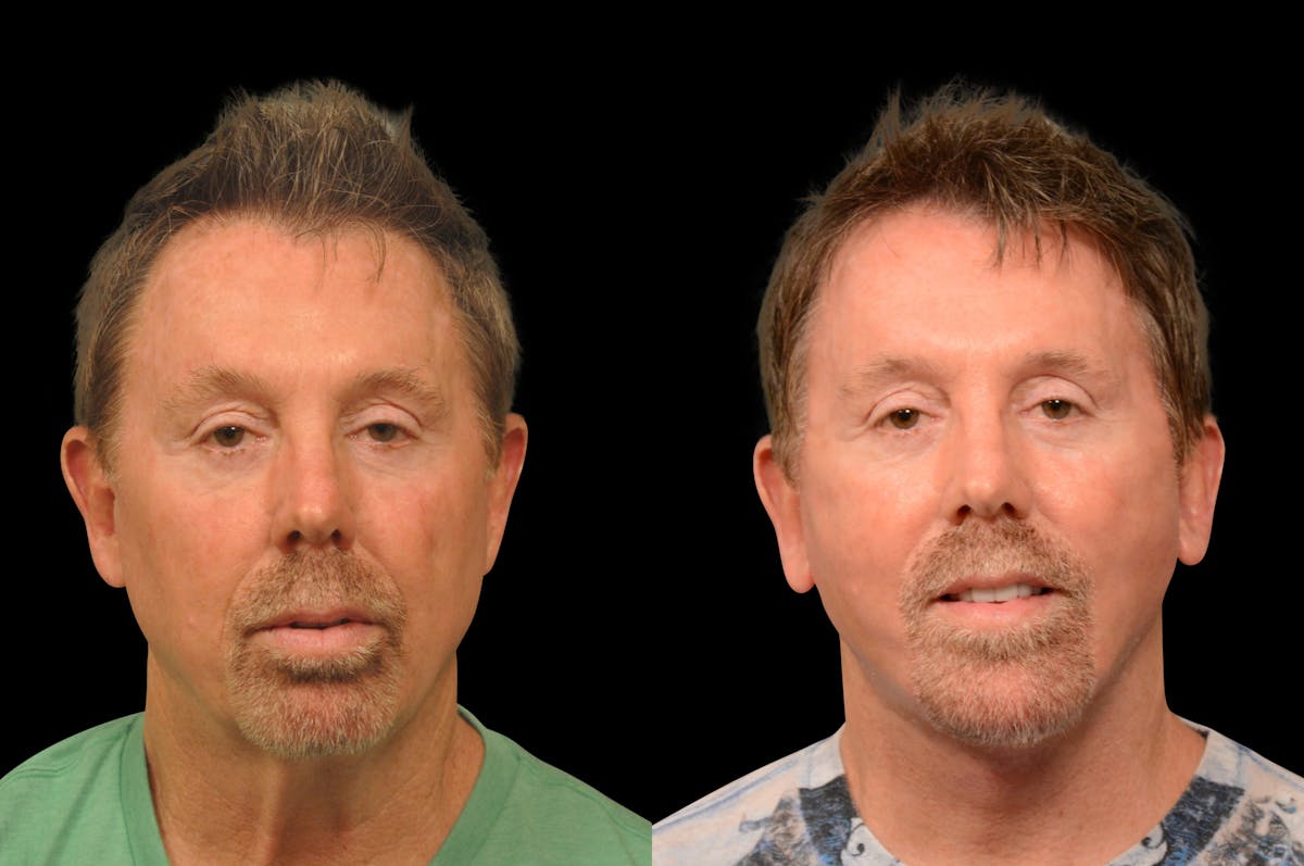 Chin Augmentation Before & After Gallery - Patient 148390 - Image 5