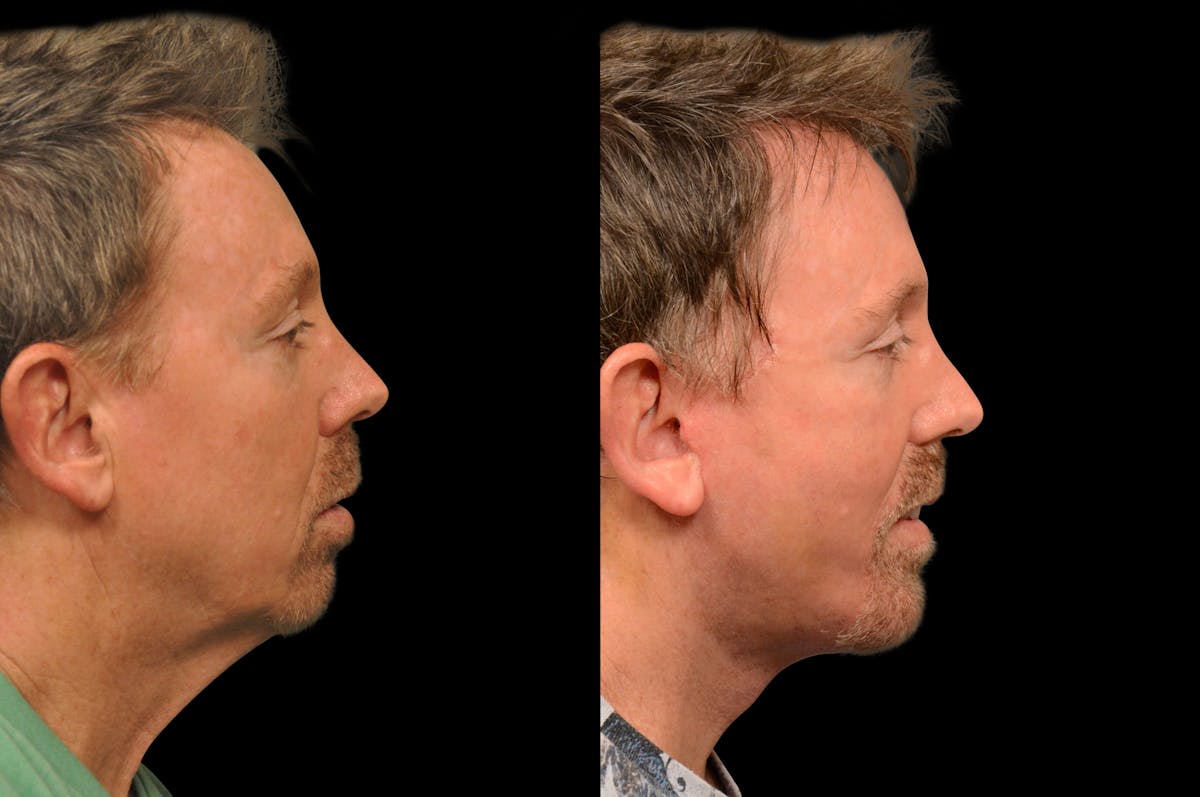 Chin Augmentation Before & After Gallery - Patient 148390 - Image 4