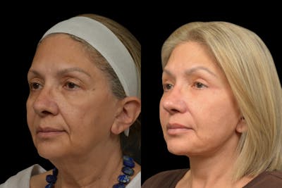 Eyelid Surgery Before & After Gallery - Patient 382967 - Image 1