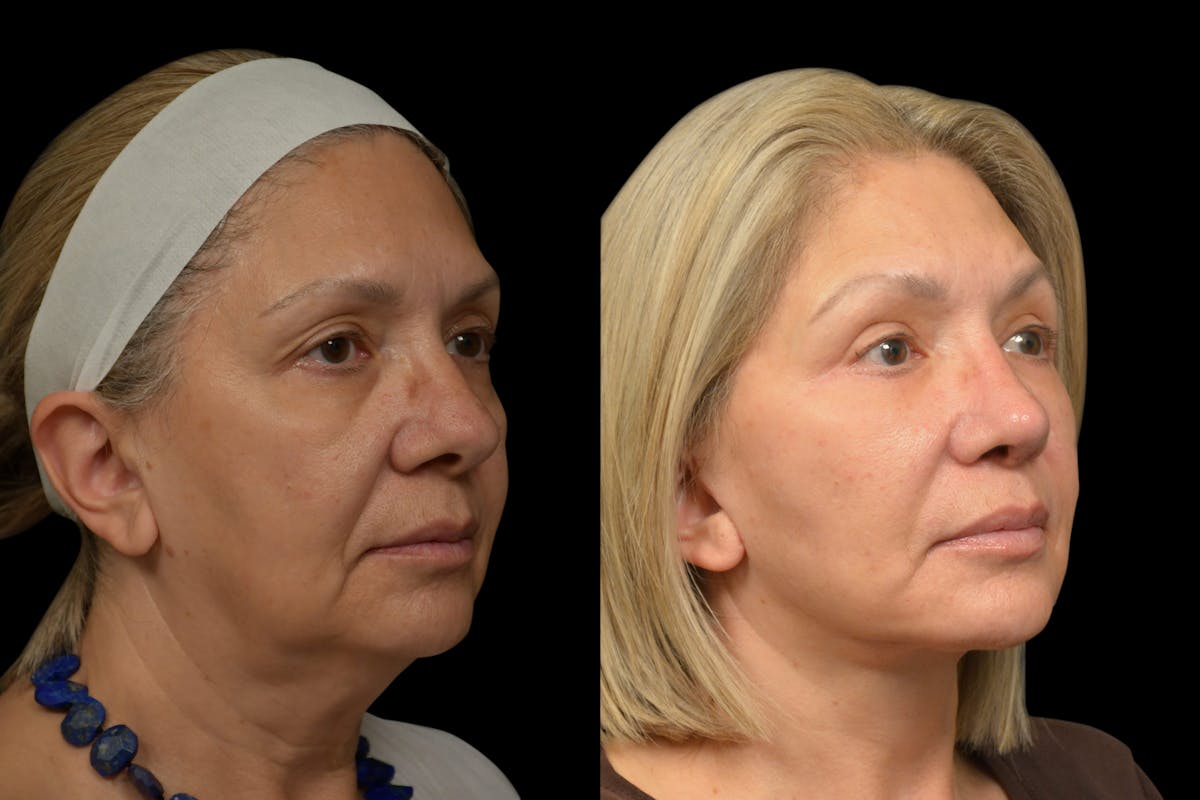 Eyelid Surgery Before & After Gallery - Patient 382967 - Image 2
