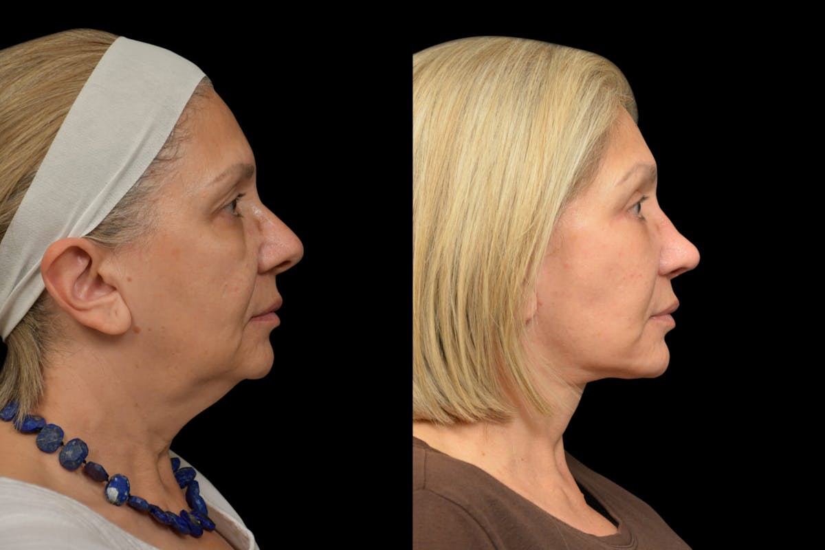 Changes Rapid Lift  Before & After Gallery - Patient 263705 - Image 3