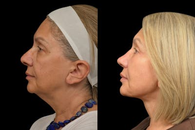 Neck Lift Before & After Gallery - Patient 355499 - Image 1