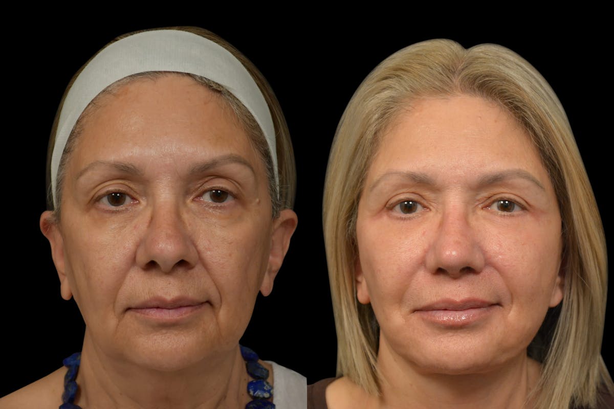 Eyelid Surgery Before & After Gallery - Patient 382967 - Image 5