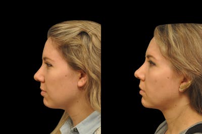 Neck Lift Before & After Gallery - Patient 159001 - Image 1