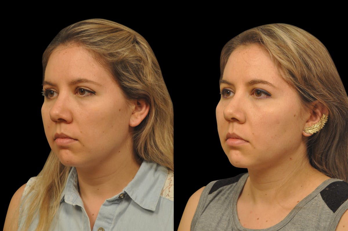 Neck Lift Before & After Gallery - Patient 159001 - Image 1