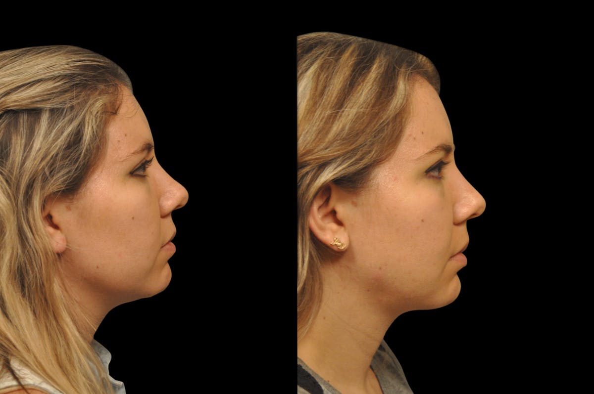 Neck Lift Before & After Gallery - Patient 159001 - Image 3