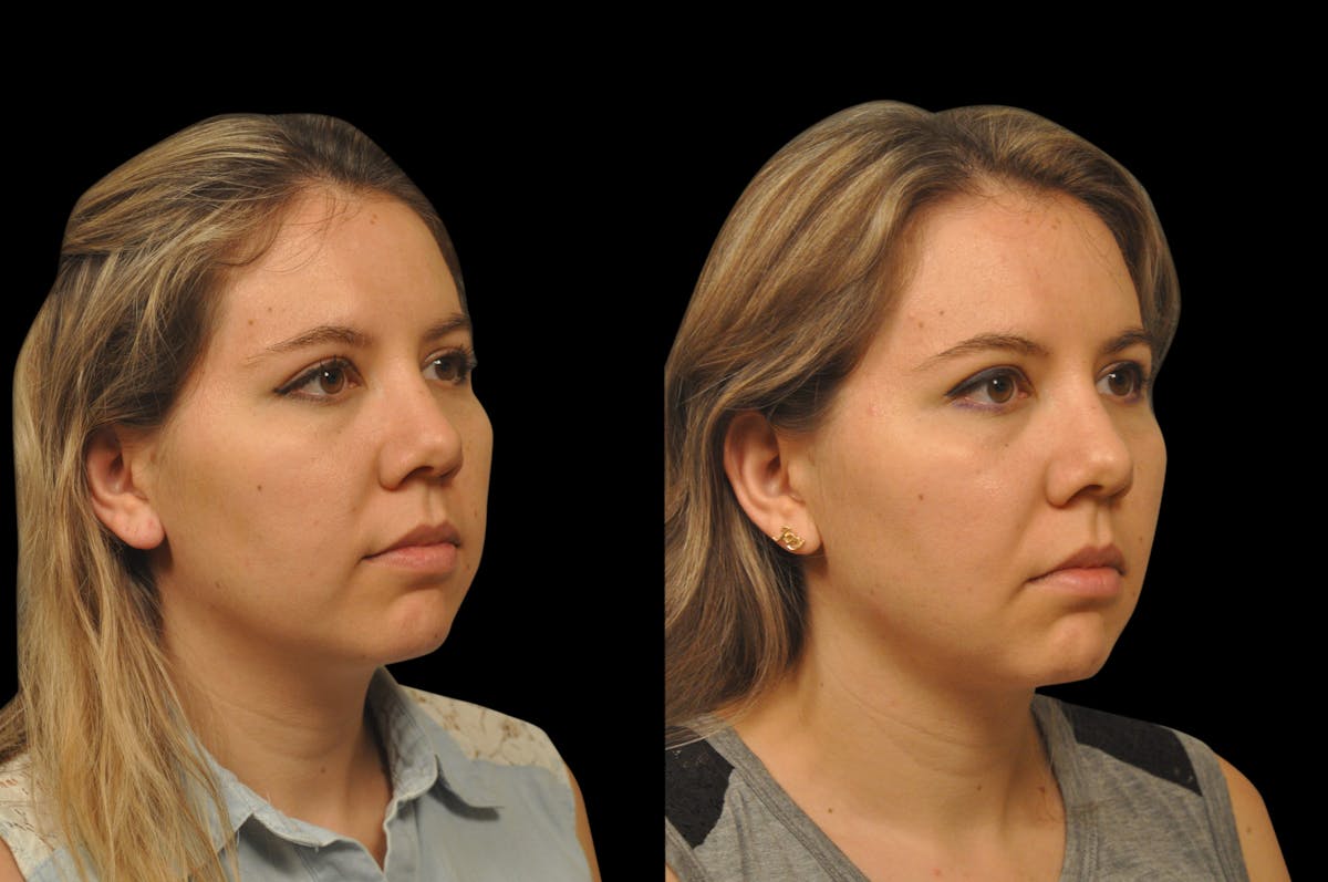 Neck Lift Before & After Gallery - Patient 159001 - Image 4