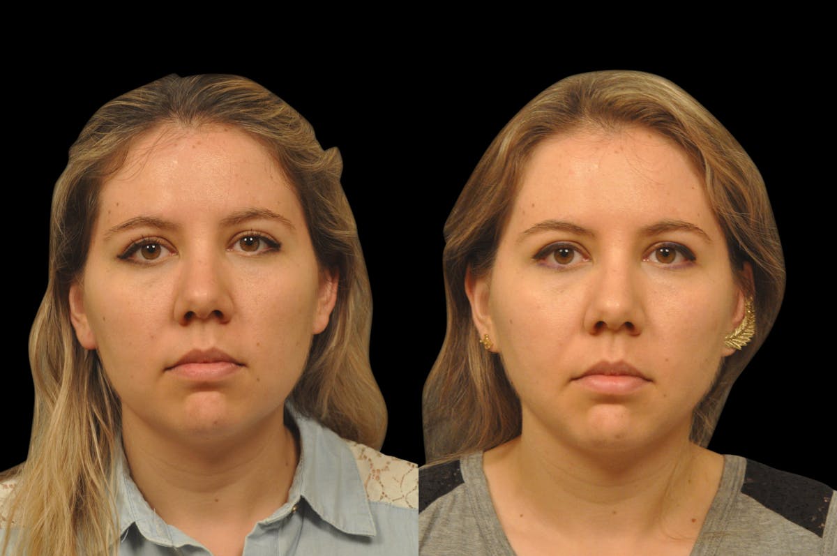 Neck Lift Before & After Gallery - Patient 159001 - Image 5