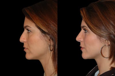 Rhinoplasty Before & After Gallery - Patient 191440 - Image 1