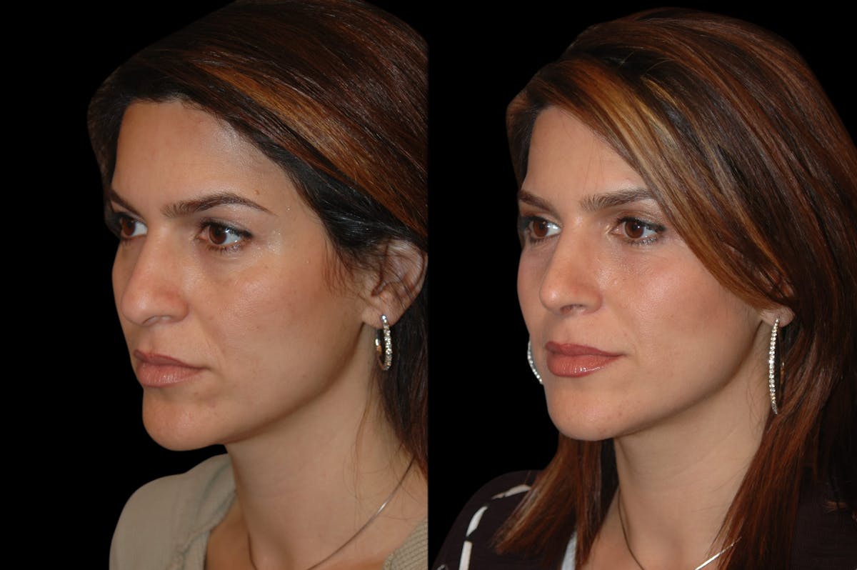 Rhinoplasty Before & After Gallery - Patient 191440 - Image 1
