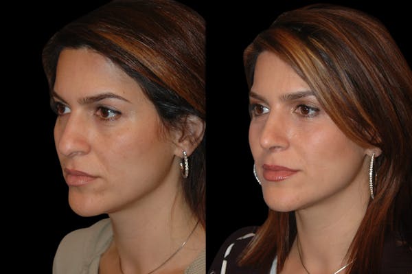 Rhinoplasty Before & After Gallery - Patient 191440 - Image 1
