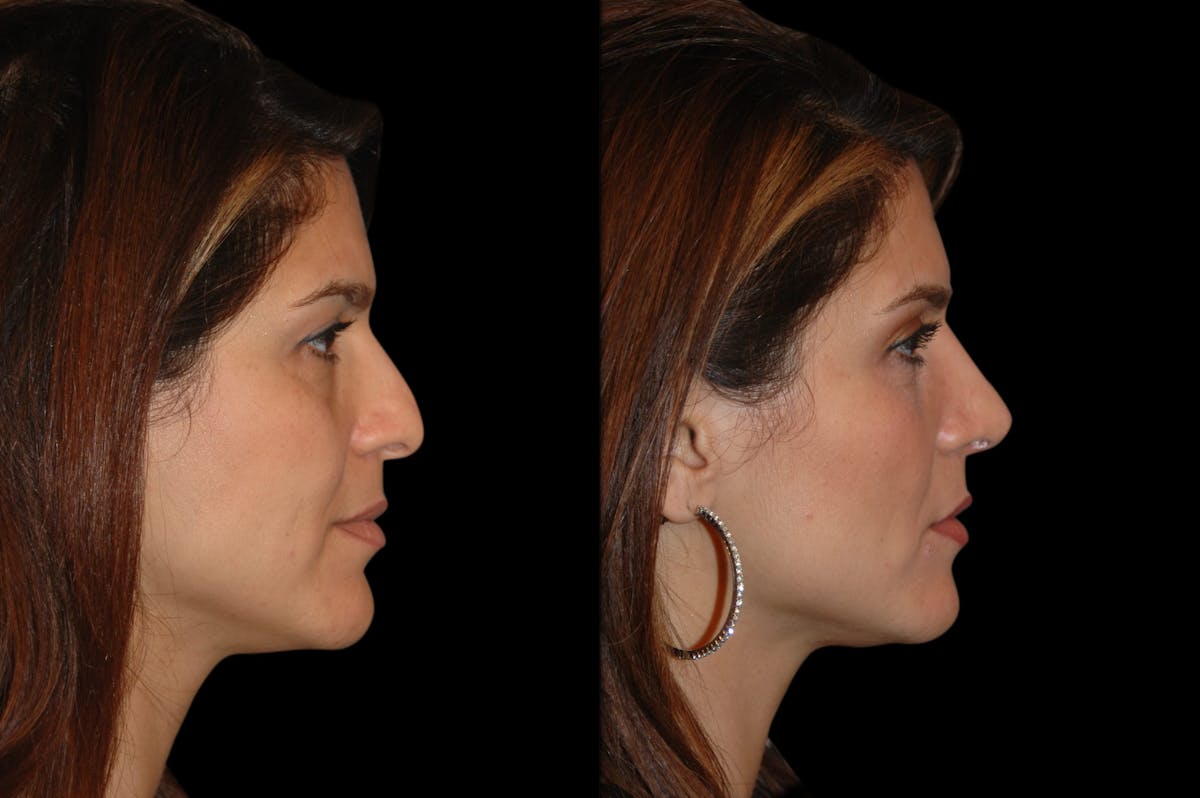Rhinoplasty Before & After Gallery - Patient 191440 - Image 3