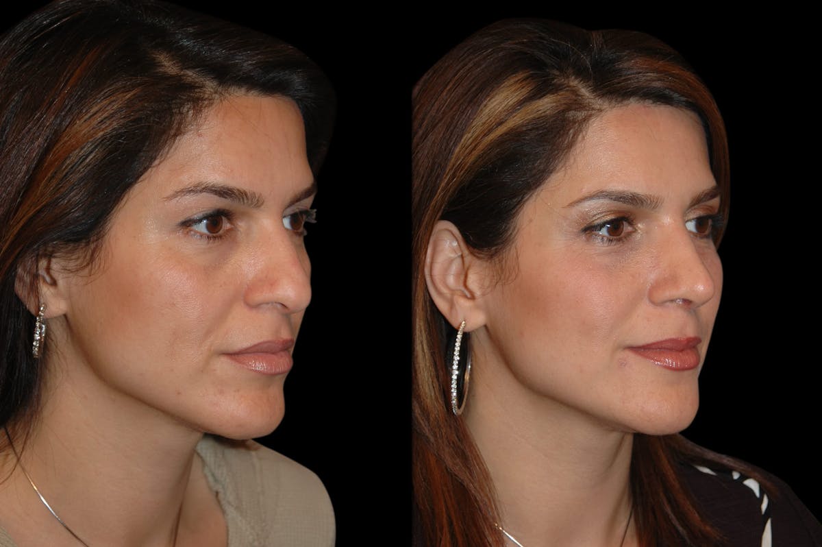 Rhinoplasty Before & After Gallery - Patient 191440 - Image 4