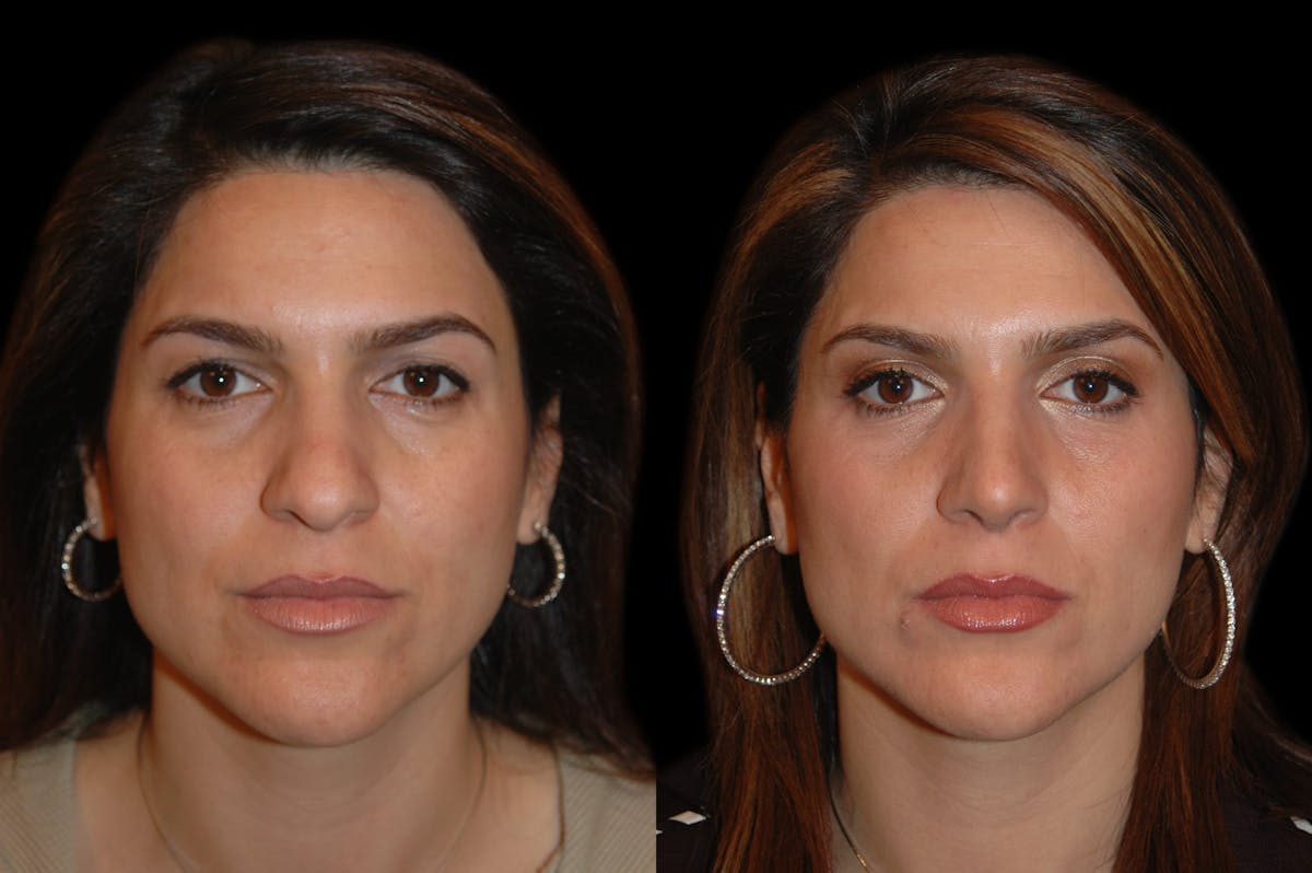 Rhinoplasty Before & After Gallery - Patient 191440 - Image 5