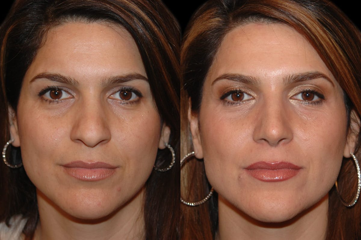 Rhinoplasty Before & After Gallery - Patient 191440 - Image 6