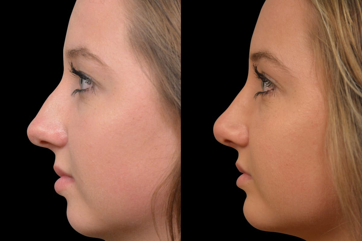 Rhinoplasty Before & After Gallery - Patient 139115 - Image 5