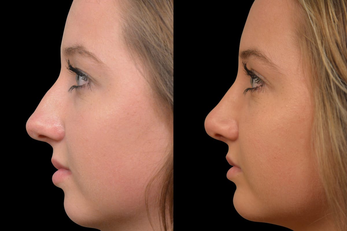 Rhinoplasty Before & After Gallery - Patient 139115 - Image 3