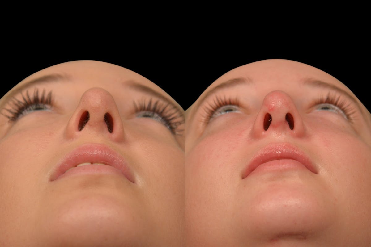Rhinoplasty Before & After Gallery - Patient 139115 - Image 7