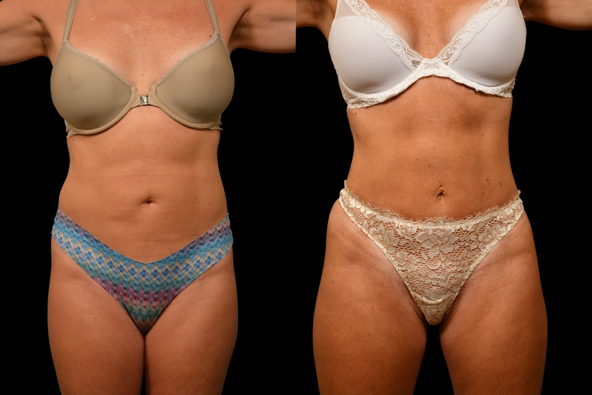 Tummy Tuck Before & After Gallery - Patient 275556 - Image 1