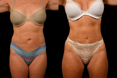 Tummy Tuck Before & After Gallery - Patient 275556 - Image 1