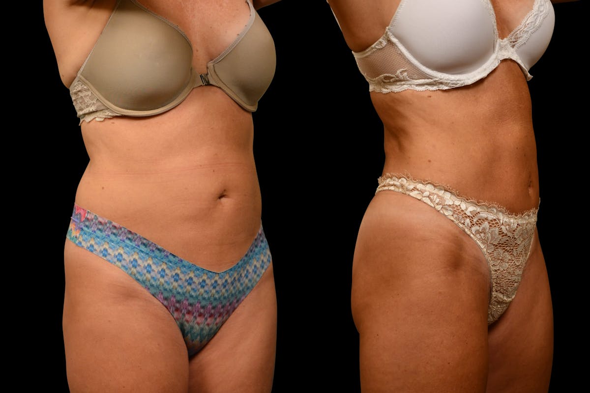 Tummy Tuck Before & After Gallery - Patient 275556 - Image 2