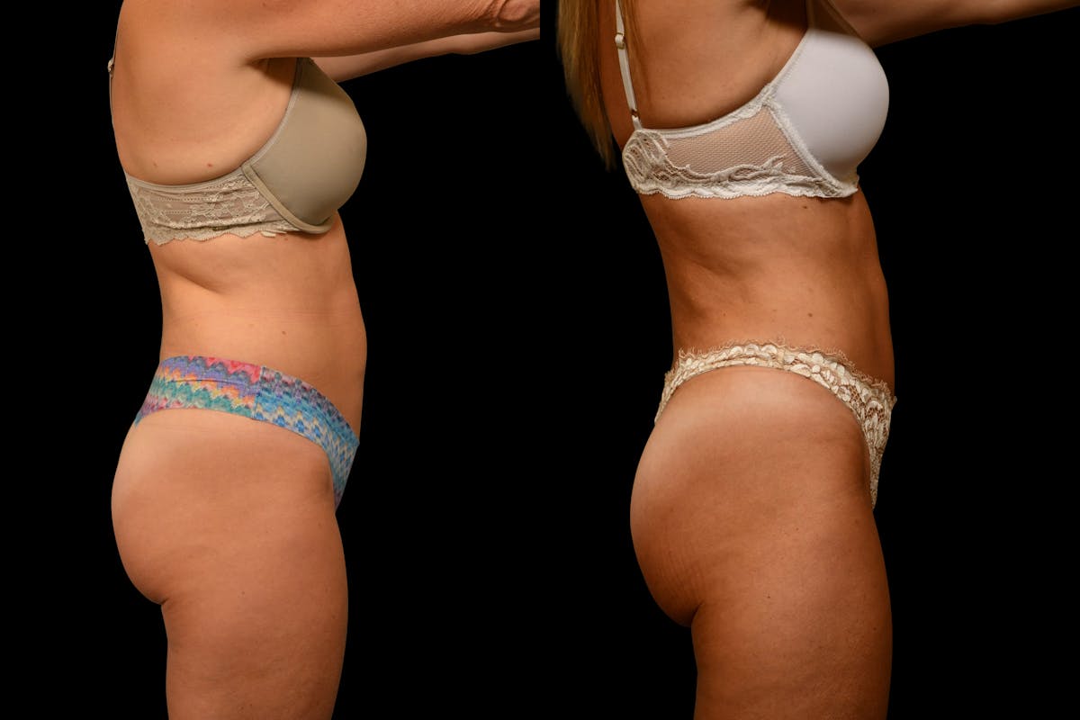 Tummy Tuck Before & After Gallery - Patient 275556 - Image 3