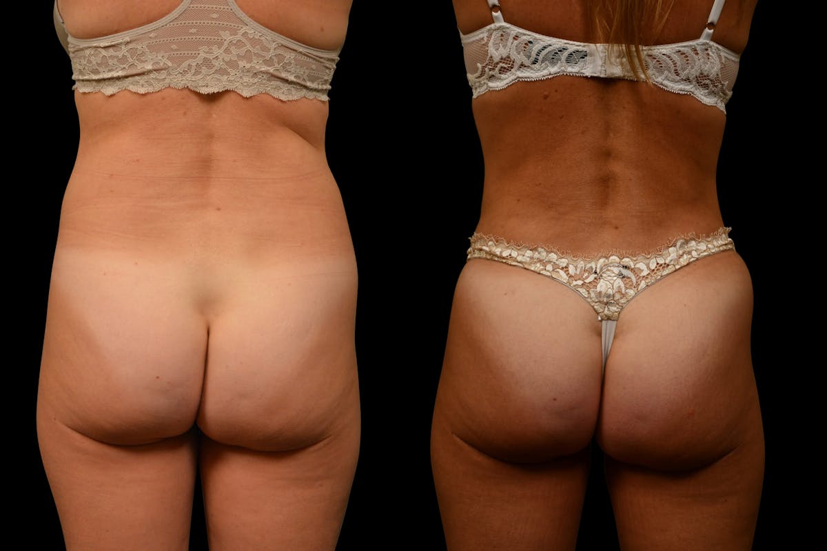 Tummy Tuck Before & After Gallery - Patient 275556 - Image 4