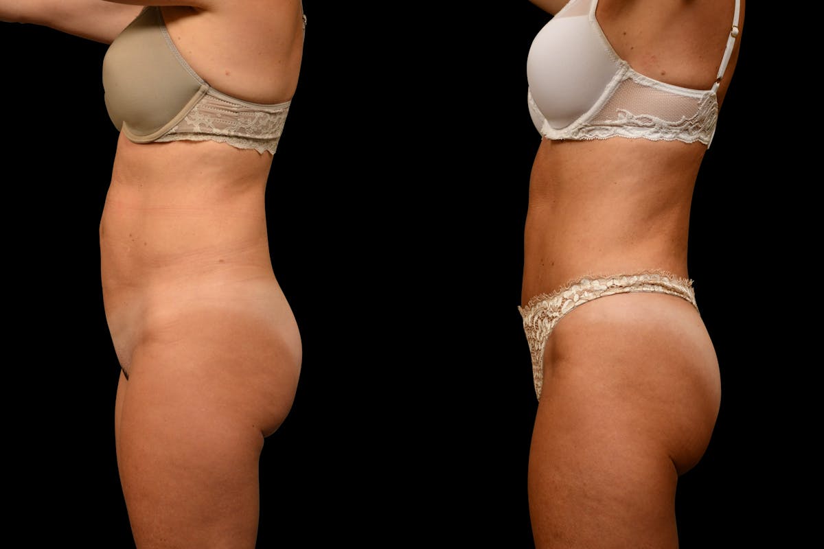 Tummy Tuck Before & After Gallery - Patient 275556 - Image 5