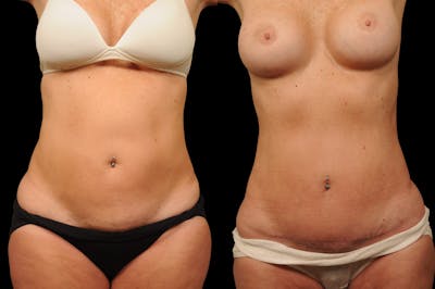 Tummy Tuck Before & After Gallery - Patient 116822 - Image 1