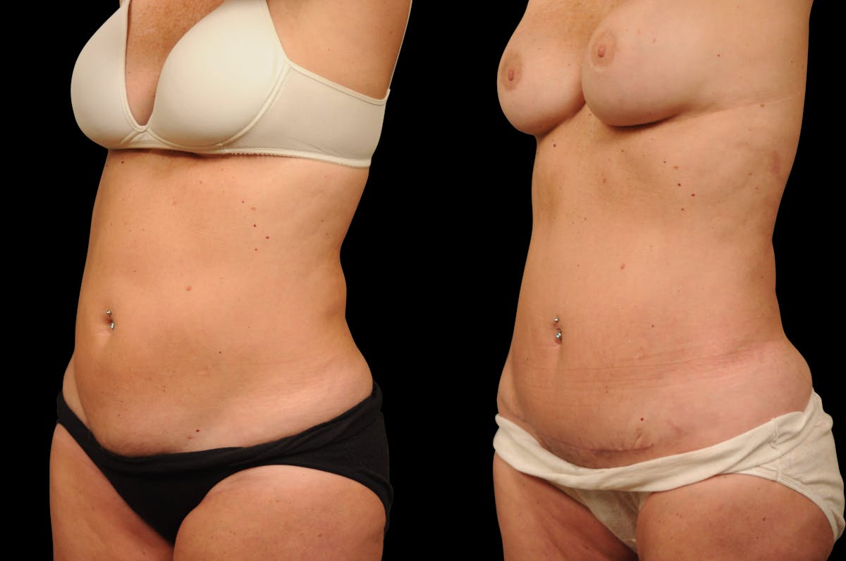 Tummy Tuck Before & After Gallery - Patient 116822 - Image 2
