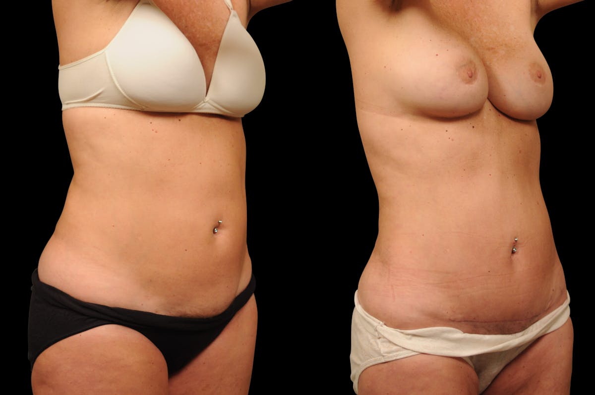 Tummy Tuck Before & After Gallery - Patient 116822 - Image 4