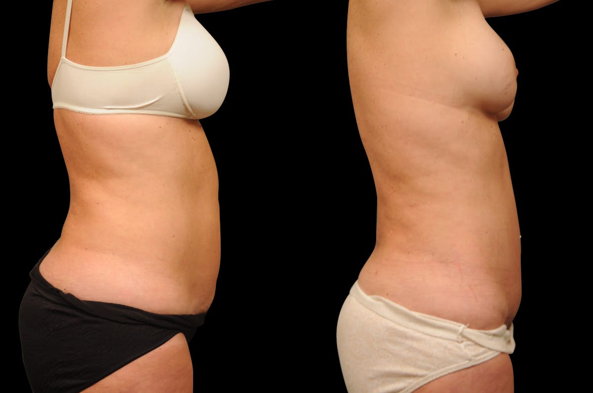 Tummy Tuck Before & After Gallery - Patient 116822 - Image 5