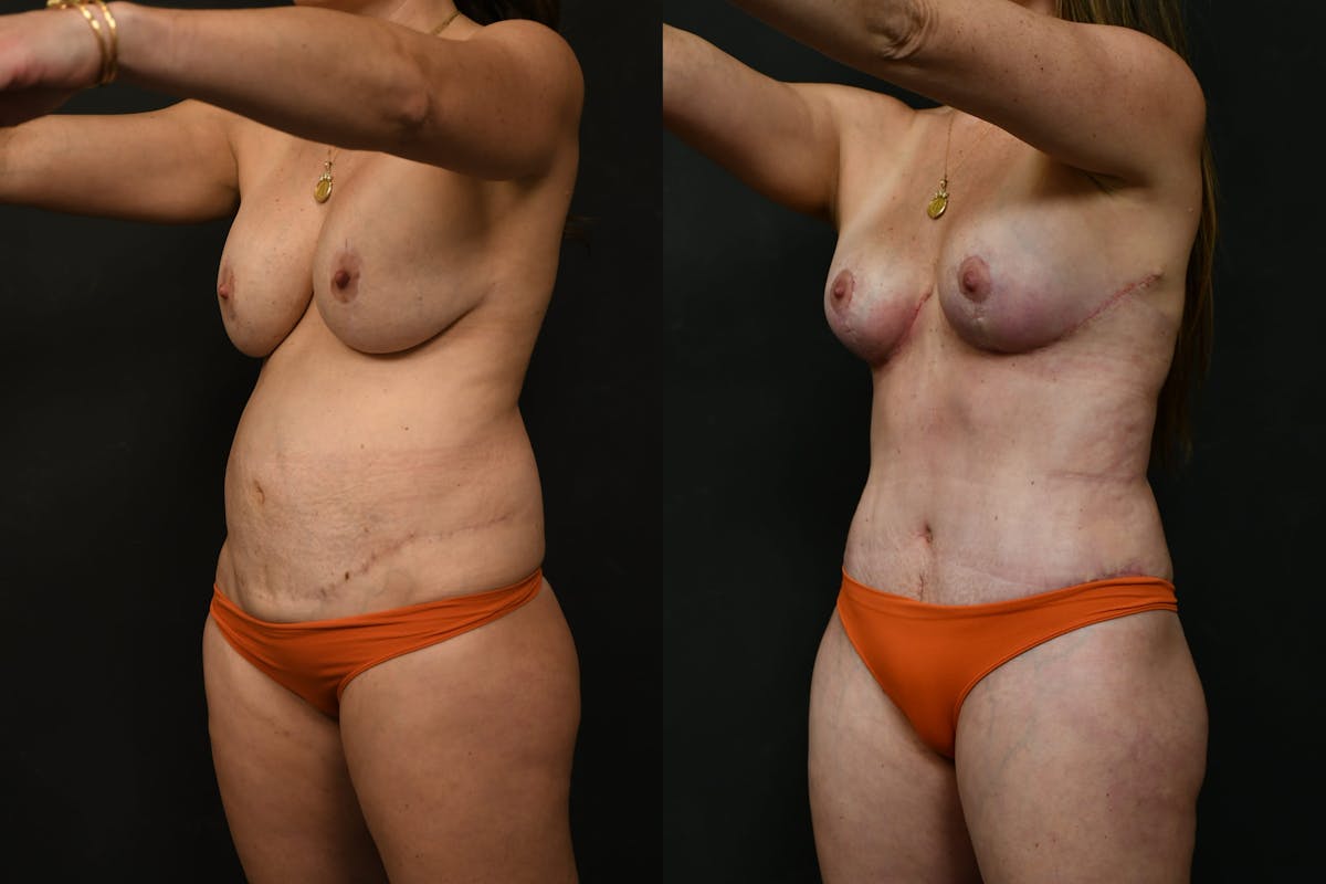 Mommy Makeover Before & After Gallery - Patient 333560 - Image 8