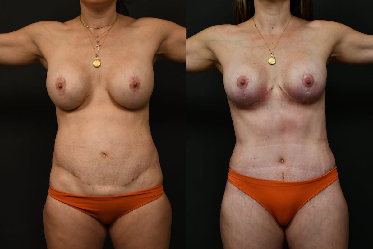 Mommy Makeover Before & After Gallery - Patient 333560 - Image 9