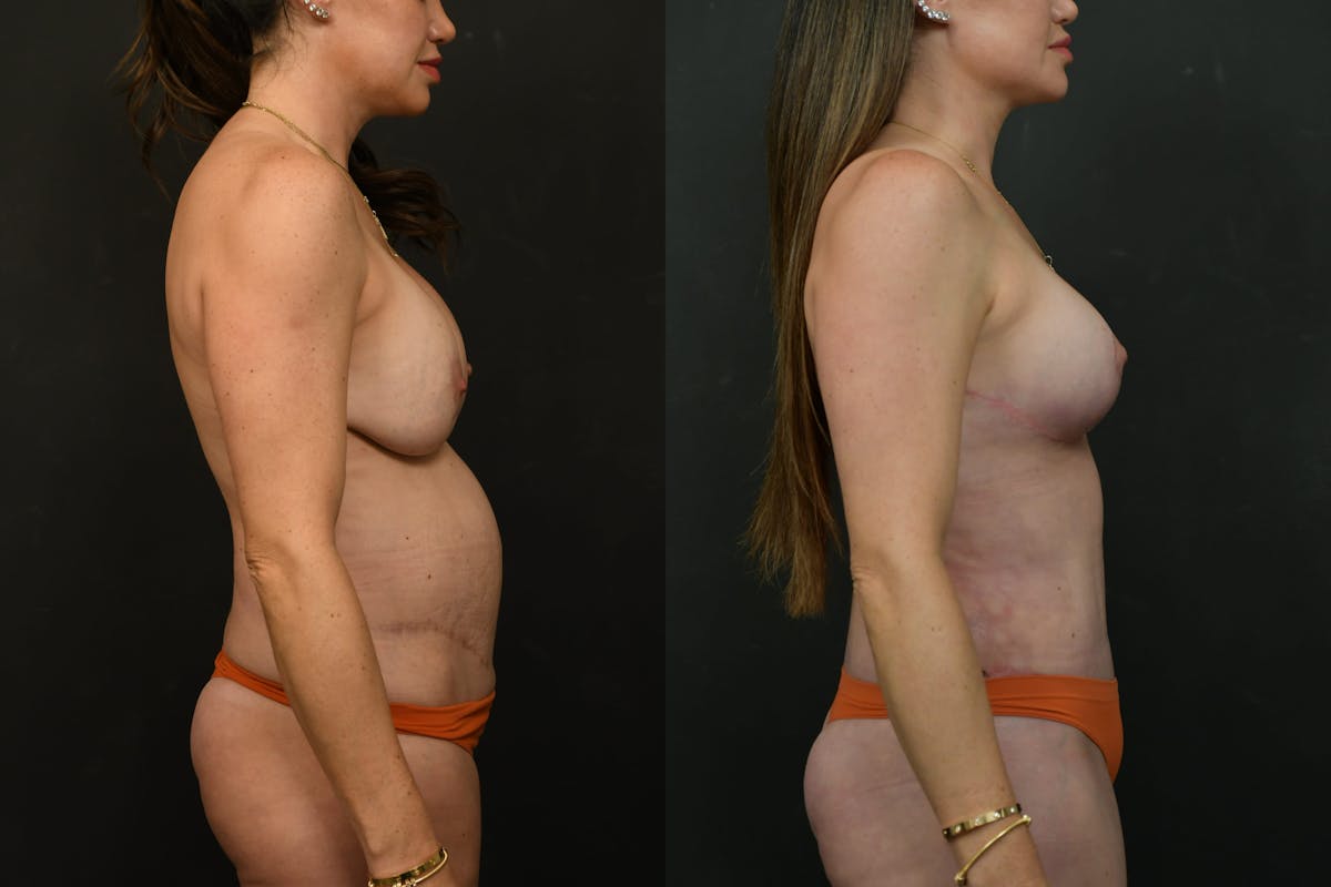 Mommy Makeover Before & After Gallery - Patient 333560 - Image 10