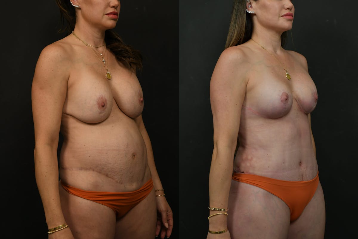 Mommy Makeover Before & After Gallery - Patient 333560 - Image 11