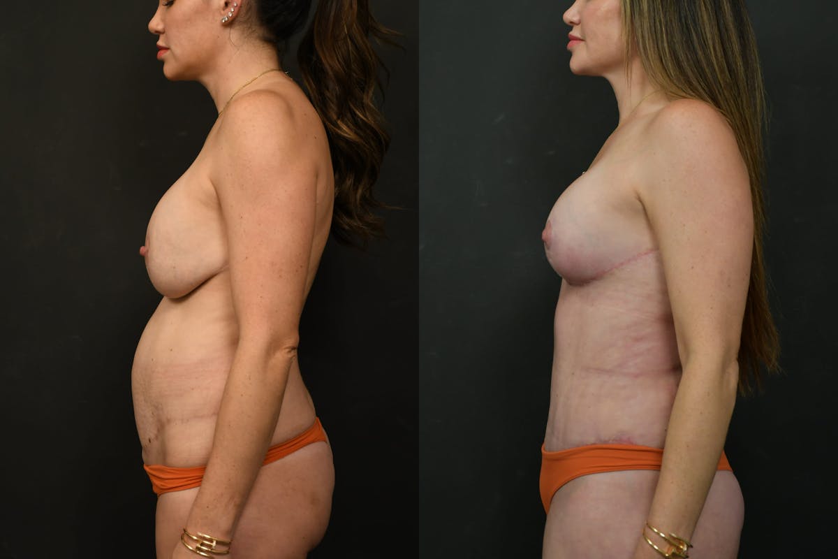 Mommy Makeover Before & After Gallery - Patient 333560 - Image 12