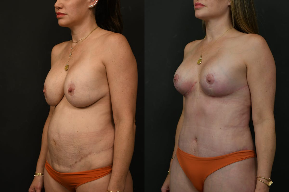 Mommy Makeover Before & After Gallery - Patient 333560 - Image 13