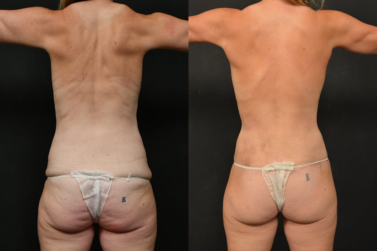 Mommy Makeover Before & After Gallery - Patient 115526 - Image 6