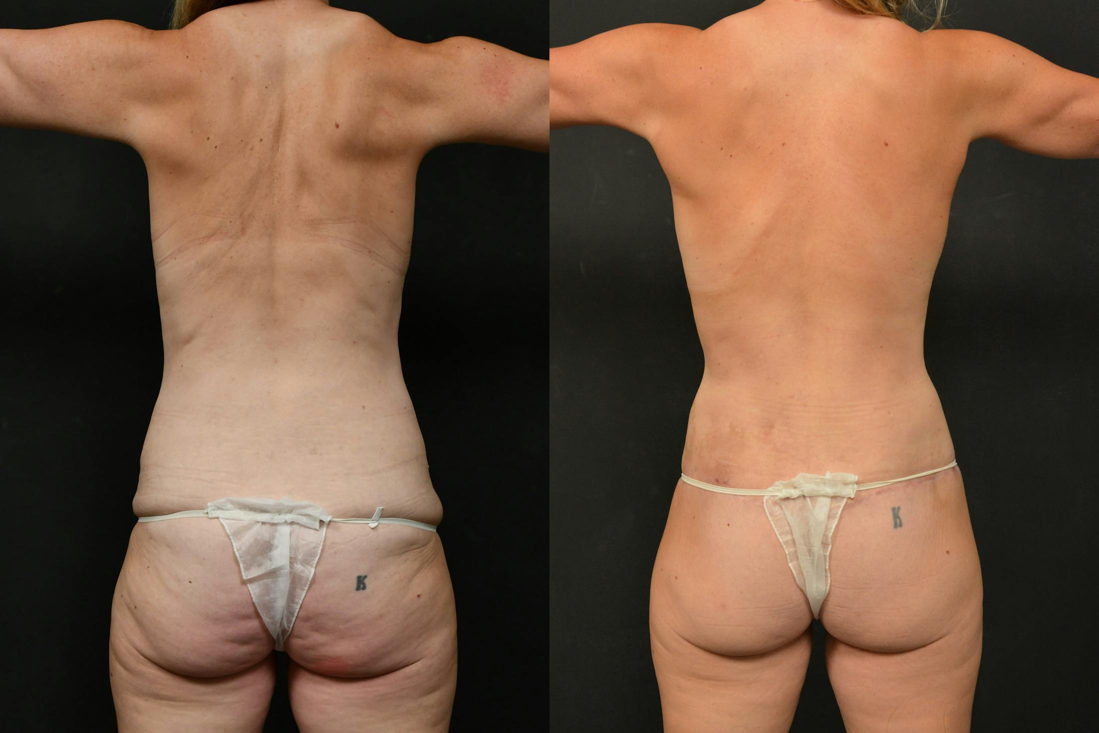 Massive Weight Loss Before & After Gallery - Patient 390908 - Image 3