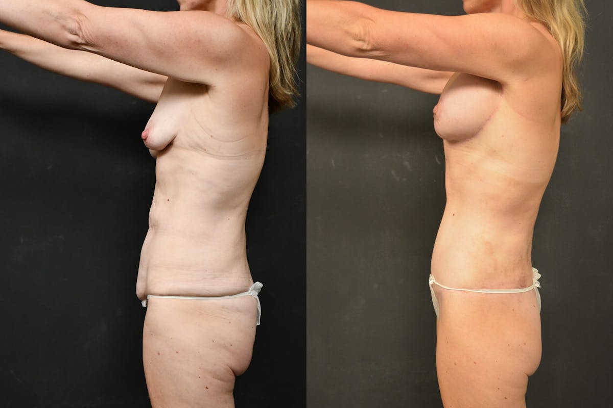 Mommy Makeover Before & After Gallery - Patient 115526 - Image 8
