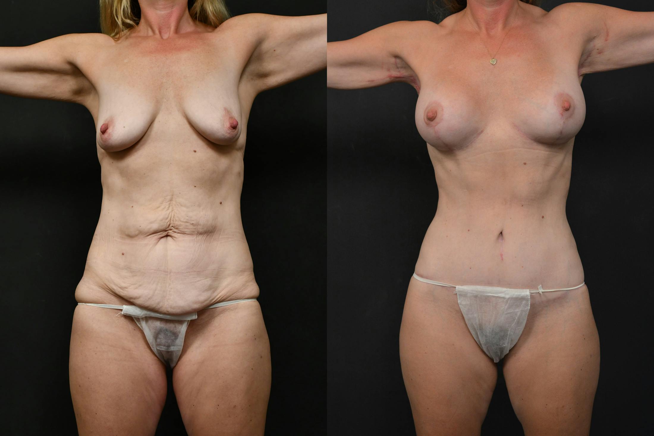 Massive Weight Loss Before & After Gallery - Patient 390908 - Image 6